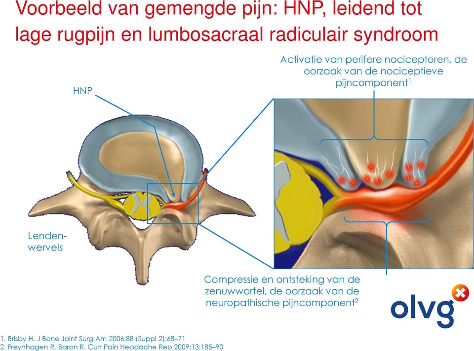 Compressie en ontsteking van de zenuwwortel, de oorzaak van de neuropathische pijncomponent 2 1.