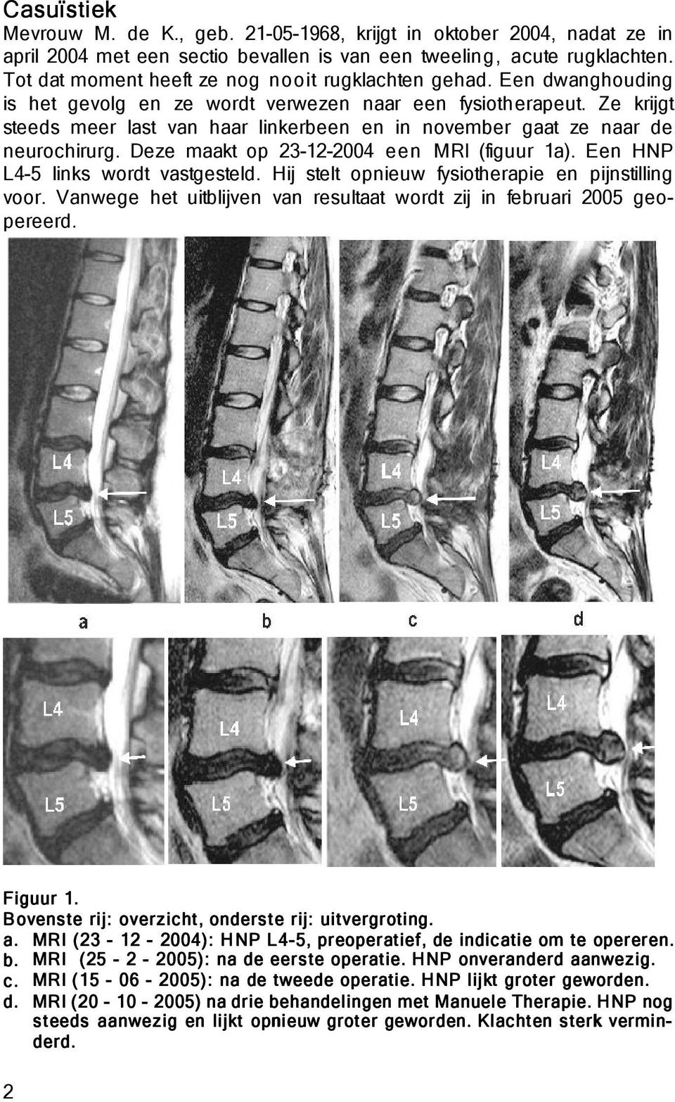 Ze krijgt steeds meer last van haar linkerbeen en in november gaat ze naar de neurochirurg. Deze maakt op 23-12-2004 een MRI (figuur 1a). Een HNP L4-5 links wordt vastgesteld.