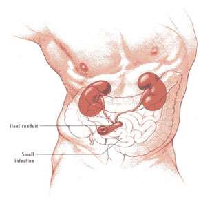 Urostoma Beide