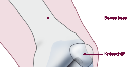 De knieprothese Waarom een prothese? Artrose of een andere reumatische aandoening kan veel pijn aan uw knie veroorzaken.