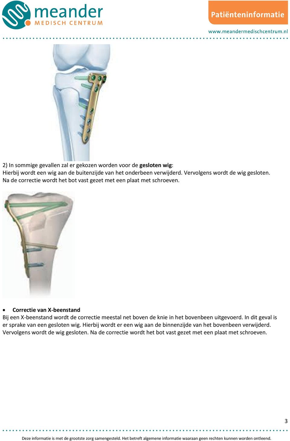 Correctie van X-beenstand Bij een X-beenstand wordt de correctie meestal net boven de knie in het bovenbeen uitgevoerd.