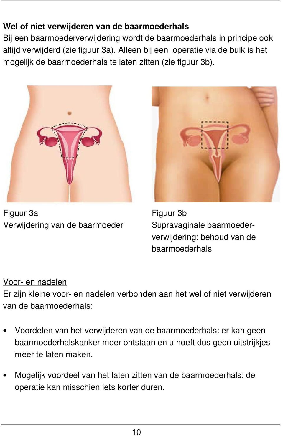 Figuur 3a Verwijdering van de baarmoeder Figuur 3b Supravaginale baarmoederverwijdering: behoud van de baarmoederhals Voor- en nadelen Er zijn kleine voor- en nadelen verbonden aan het