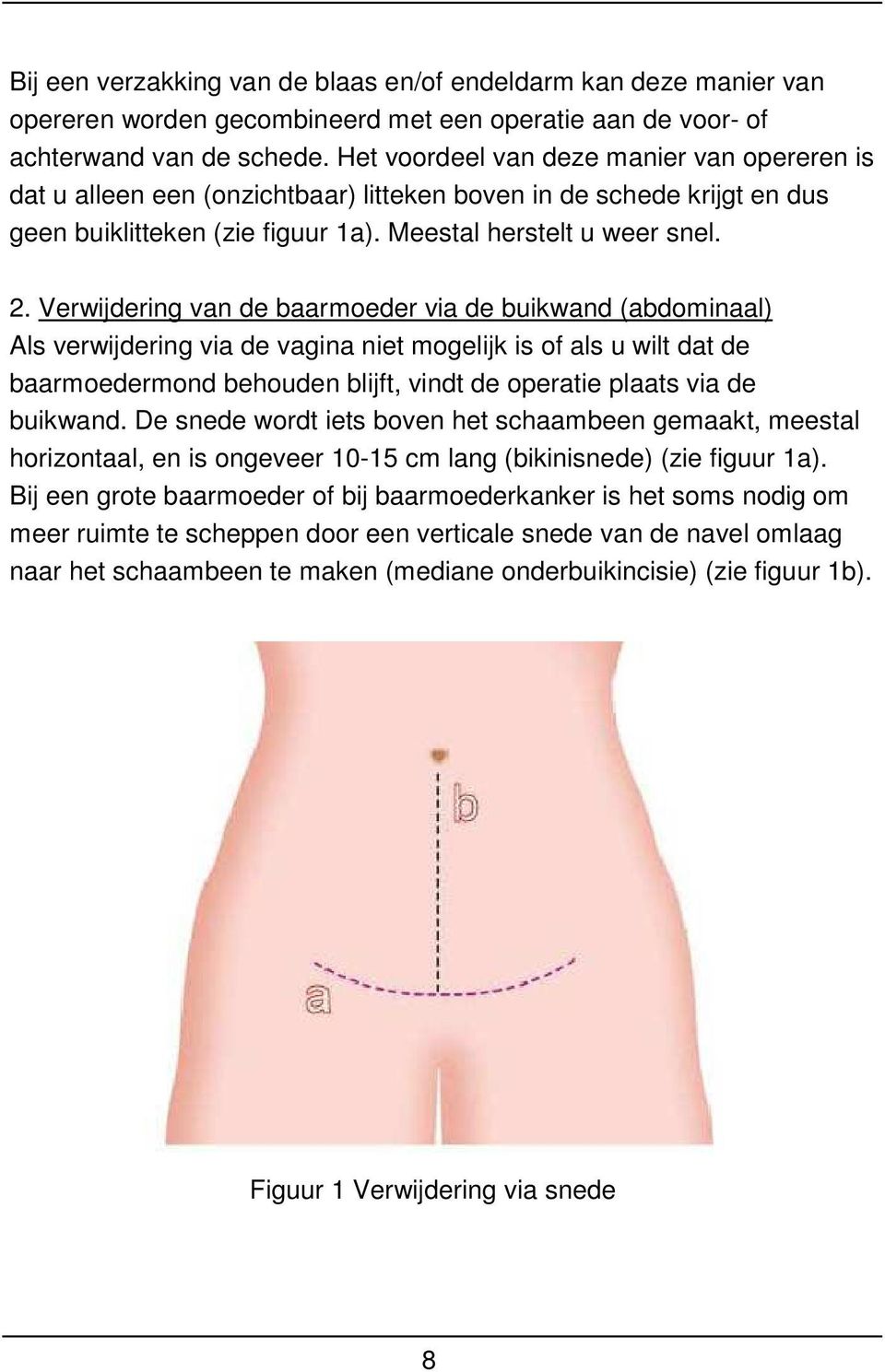 Verwijdering van de baarmoeder via de buikwand (abdominaal) Als verwijdering via de vagina niet mogelijk is of als u wilt dat de baarmoedermond behouden blijft, vindt de operatie plaats via de