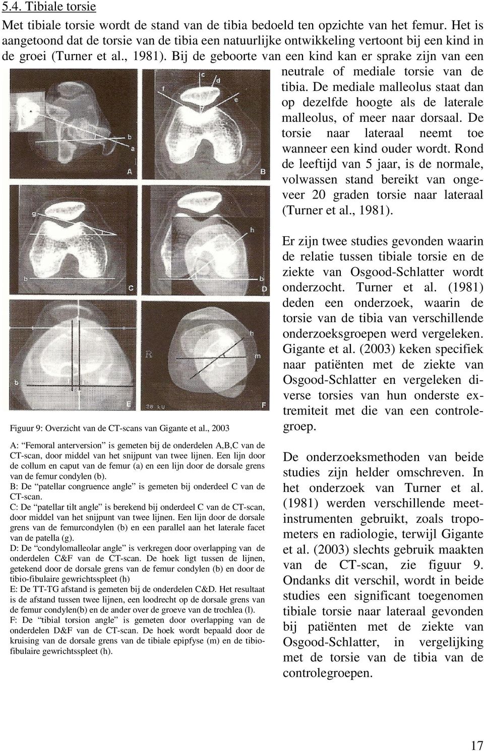 Bij de geboorte van een kind kan er sprake zijn van een neutrale of mediale torsie van de tibia. De mediale malleolus staat dan op dezelfde hoogte als de laterale malleolus, of meer naar dorsaal.