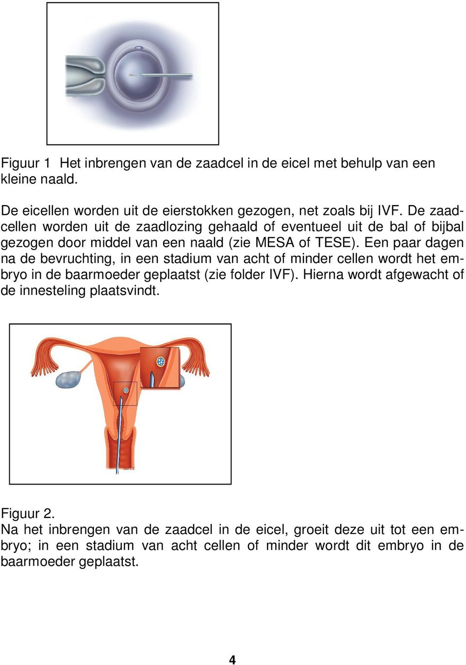 Een paar dagen na de bevruchting, in een stadium van acht of minder cellen wordt het embryo in de baarmoeder geplaatst (zie folder IVF).