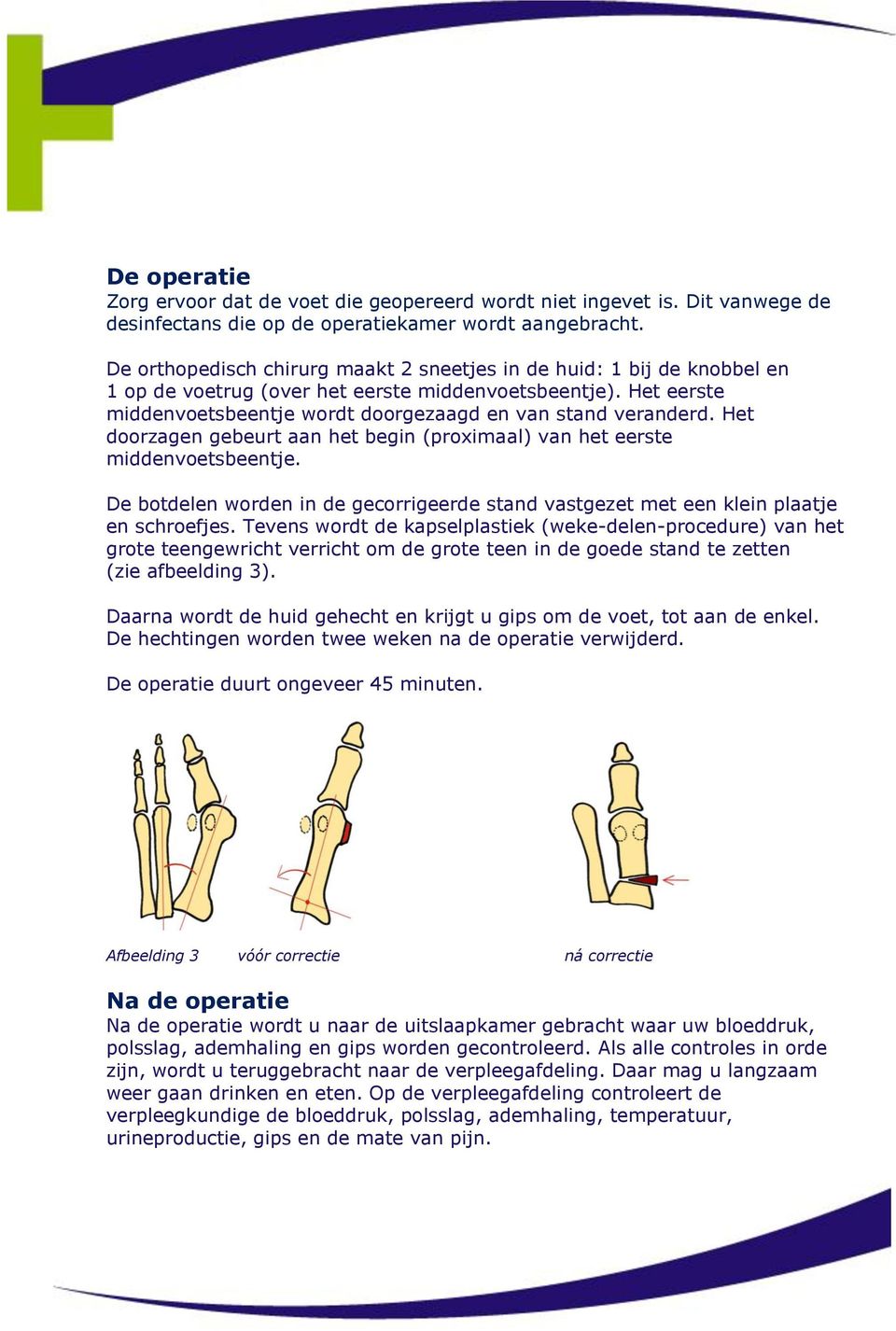 Het doorzagen gebeurt aan het begin (proximaal) van het eerste middenvoetsbeentje. De botdelen worden in de gecorrigeerde stand vastgezet met een klein plaatje en schroefjes.