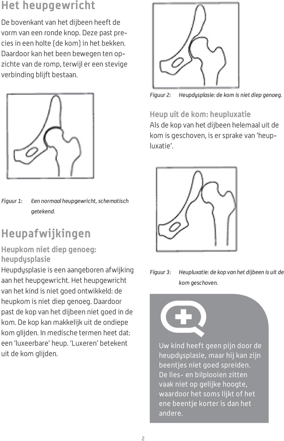 Heup uit de kom: heupluxatie Als de kop van het dijbeen helemaal uit de kom is geschoven, is er sprake van heupluxatie. Figuur 1: Een normaal heupgewricht, schematisch getekend.