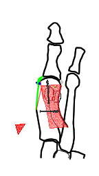 Schematische weergave Chevron osteotomie 3. Scarf osteotomie De Scarf osteotomie kan een matige tot ernstige Hallux Valgus corrigeren.