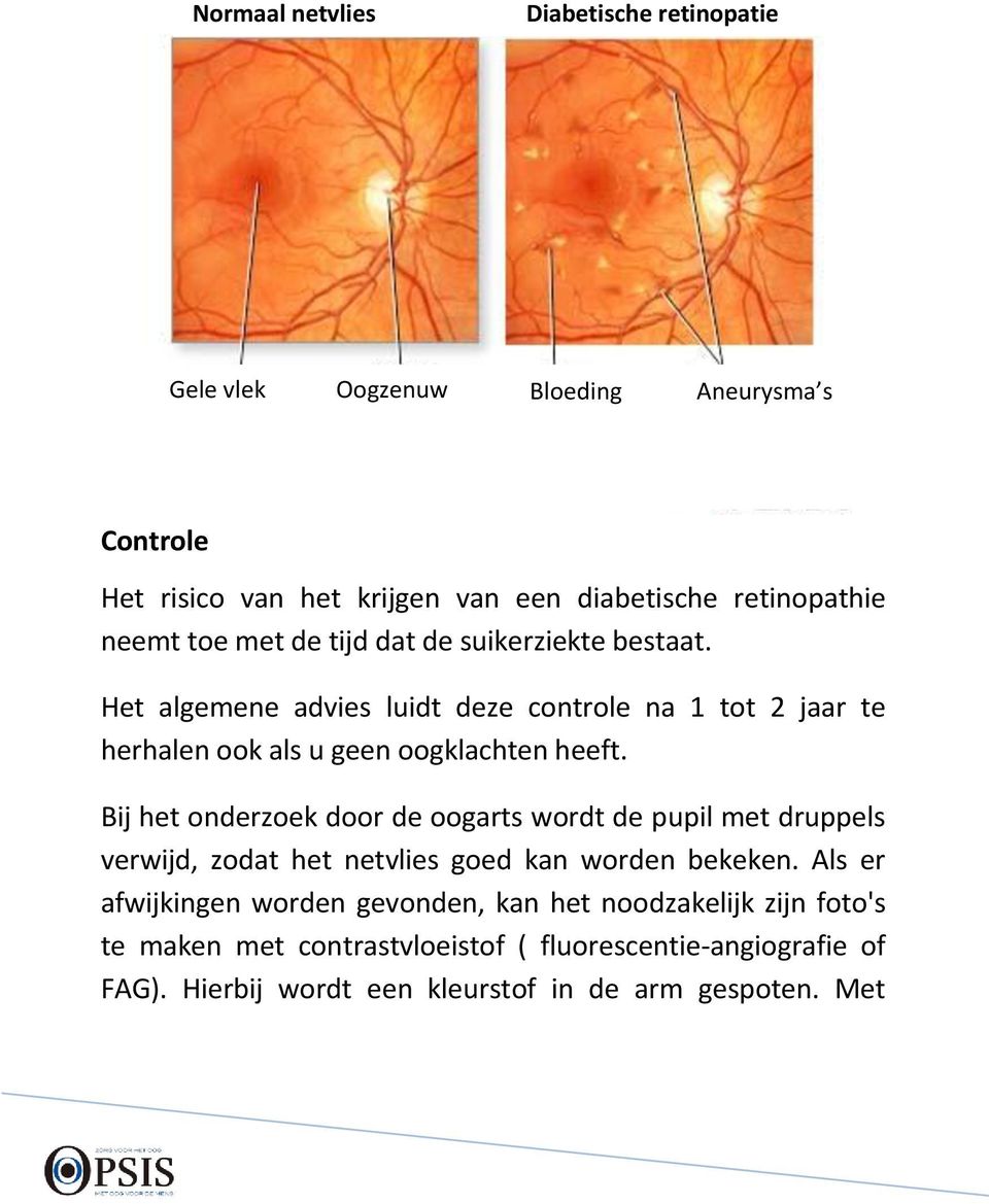 Bij het onderzoek door de oogarts wordt de pupil met druppels verwijd, zodat het netvlies goed kan worden bekeken.