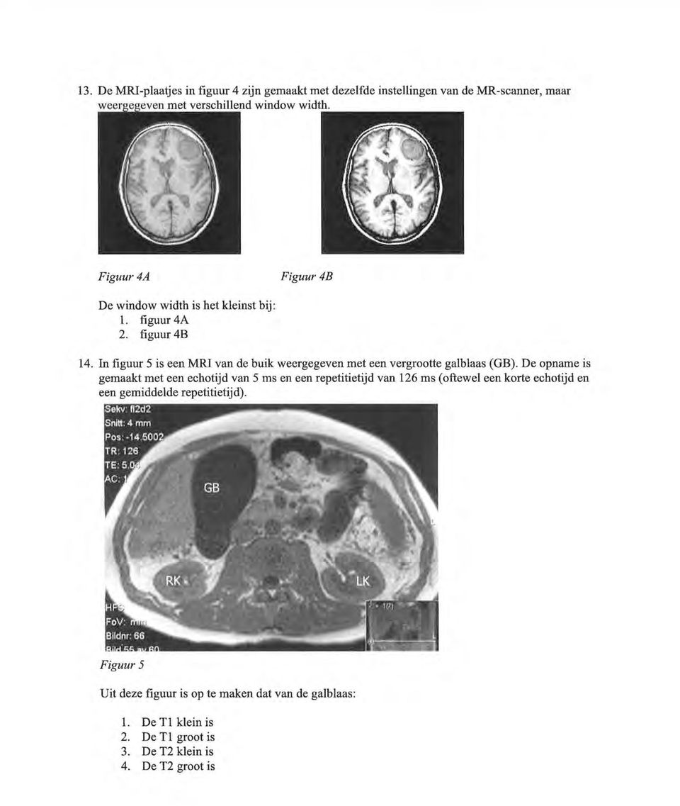 In figuur 5 is een MRI van de buik weergegeven met een vergrootte galblaas (GB).