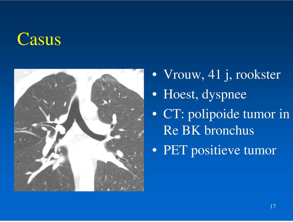 CT: polipoide tumor in Re