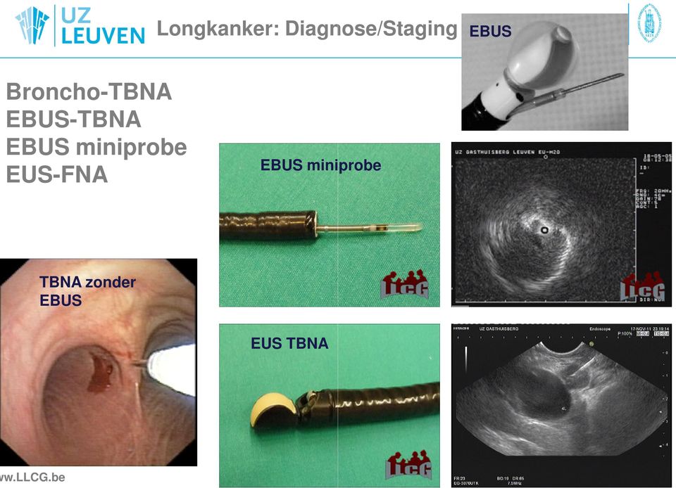 miniprobe EUS-FNA EBUS miniprobe