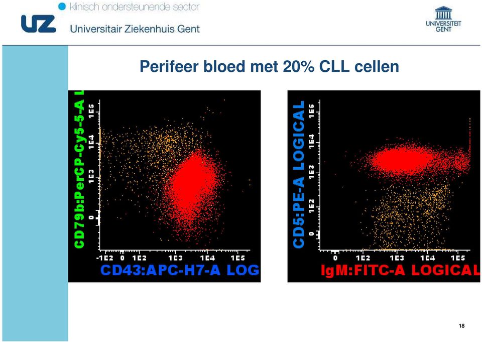 20% CLL