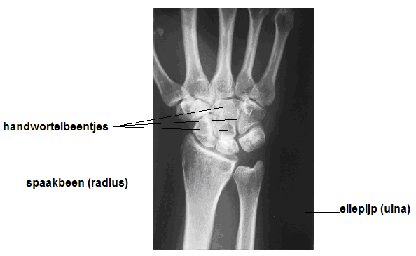 Algemeen De pols wordt gevormd door het spaakbeen (radius) en de ellepijp (ulna) in de onderarm en acht handwortelbeentjes in de hand (zie afb. 1).