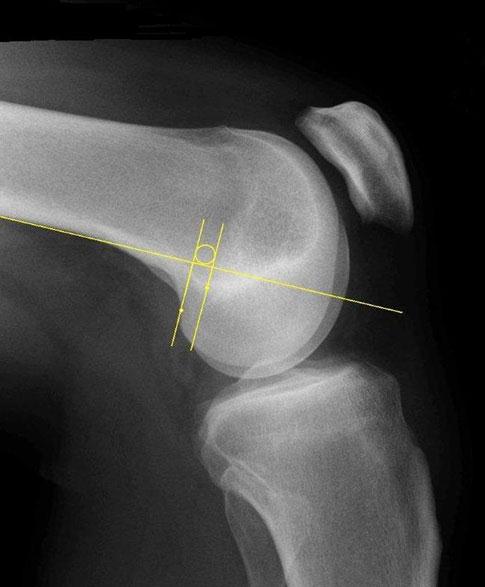 komt een rechte door het contactpunt met de mediale femurcondyl (lijn 2) en een rechte door het meest posterieure punt van de Blumensaat lijn (lijn 3) (43, 54).