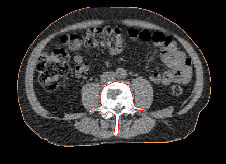 First In Man Simulatie CT-scan