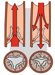 Thoraxcentrum Hartkatheterisatie Aortaklepimplantatie via de liesslagader (TAVI -TF) Inleiding Deze brochure is geschreven voor patiënten die een afwijking aan de aortaklep hebben en die een