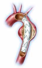 Endoprothese Voor de behandeling van een aneurysma of aortadissectie type B kan een thoracale endoprothese een mogelijkheid zijn. Dit is een opgevouwen prothese die via de lies geplaatst wordt.