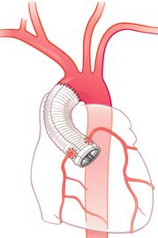 Open hartoperatie Aortaprothese Voor een thoracaal aneurysma van de aorta (diameter vanaf 45 mm bij het syndroom van Marfan of bicuspide aortakleppen; bij andere aandoeningen > 55mm) en een type