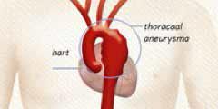Wat is een aneurysma? Een aneurysma is een verwijding (uitstulping) van een bloedvat in het vaatstelsel. Aneurysmata kunnen in alle bloedvaten voorkomen: in slagaders, aders en het hart.