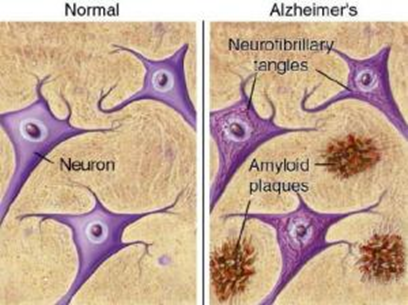 Oorzaak van Alzheimer demen(e Oorzaak niet bekend Stapeling Alzheimer eiwiaen - amyloid-beta à plaques - tau à tangles