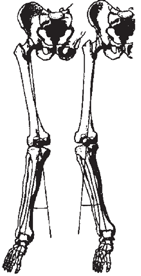 Artrose zit vaak aan één kant van het kniegewricht: de binnenkant of de buitenkant van de knie. Door botverlies aan één kant gaat de knie naar de andere kant uitwijken.