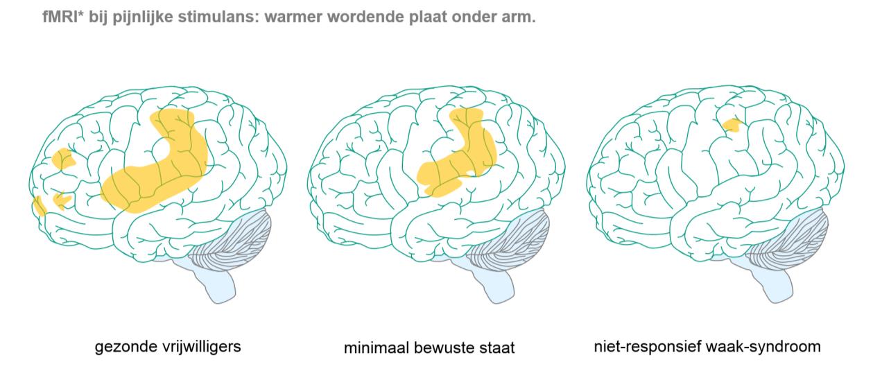 Studies naar perceptie van pijn bij UWS/MCS patiënten: * schematische weergave, gebaseerd