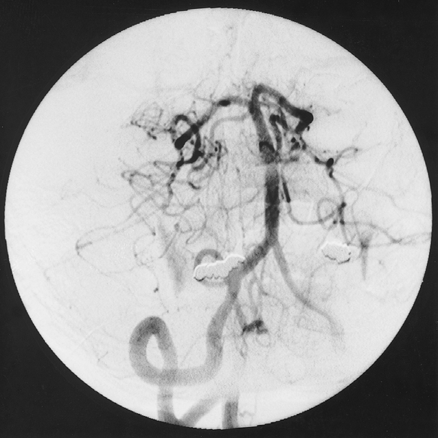 het eerste angiogram en bij 1 werd het angiogram niet herbeoordeeld, omdat de opnamen niet meer beschikbaar waren. Bij 1 patiënt was op het derde angiogram voor het eerst een aneurysma van de A.