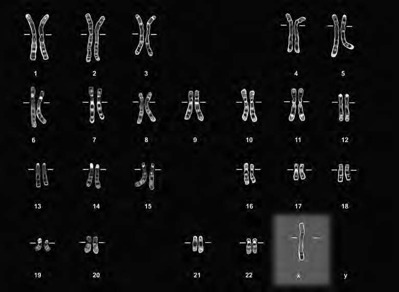 Die meeste mans met Klinefelter-sindroom het een ekstra kopie van die X-chromosoom in elke sel (XXY) en n totaal van 47 chromosome in al hulle selle.