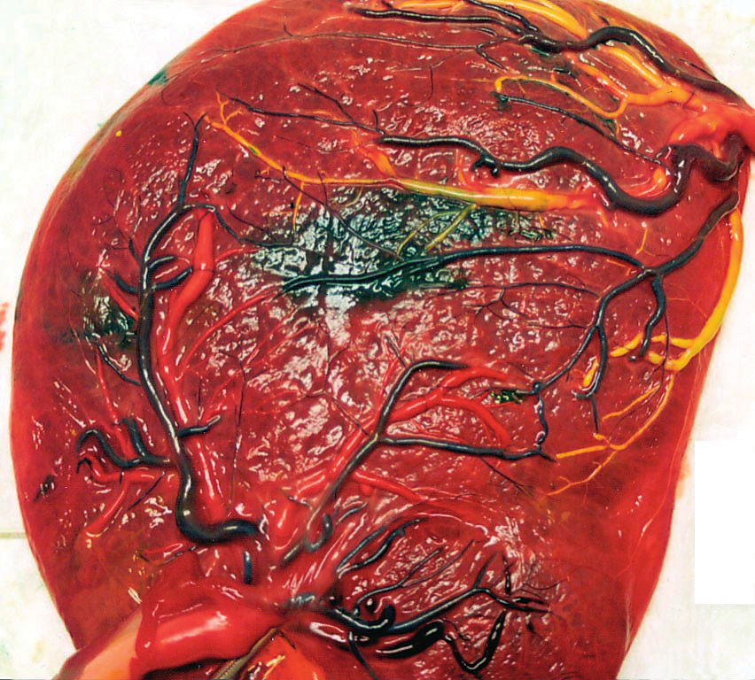 arterioveneuze anastomose (B-A) navelstreng A navelstreng B arterioveneuze anastomose (A-B) arterioarteriële anastomose figuur 1. Monochoriale placenta, geboren bij 36 weken.