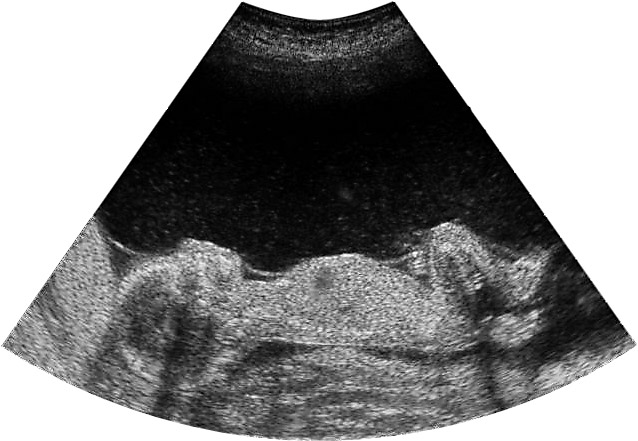 resultaten De mediane zwangerschapsduur bij de ingreep was 20 weken (uitersten: 16-26). Ruim 90% van de behandelingen vond plaats voor een TTS-Quintero-stadium II of III (tabel 2).