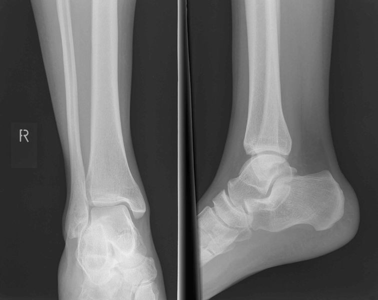 In overleg met uw behandelend arts heeft u besloten tot een operatie voor een enkelprothese of een enkelarthrodese op de afdeling Reumatologie of Orthopedie van het Radboudumc.