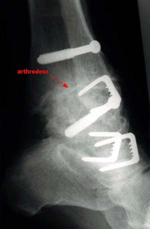 Enkelarthrodese Bij een enkelarthrodese (afbeelding 3) haalt de orthopeed het gewricht weg en zet de botten aan elkaar met schroeven en metaalklemmen.