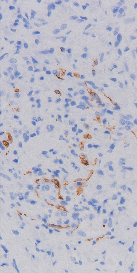 stroma myofibroblast degeneratief spierweefsel b myofibroblast a atrofische spiervezel c FIGUUR 4 Microscopische opnamen van het naaldbiopt van de halszwelling van patiënt A.