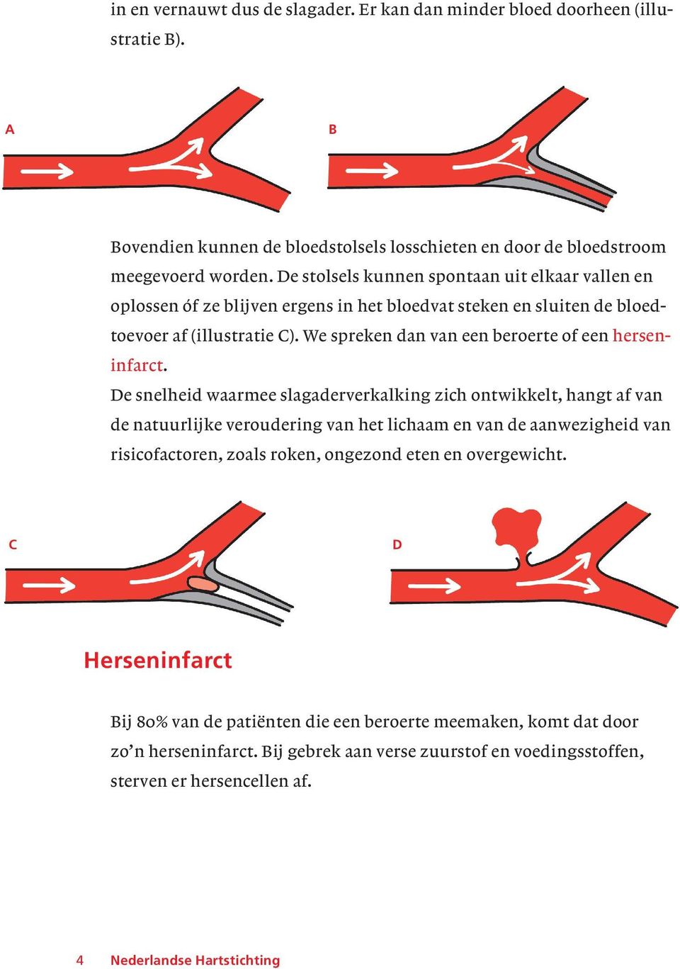 We spreken dan van een beroerte of een hersen - infarct.