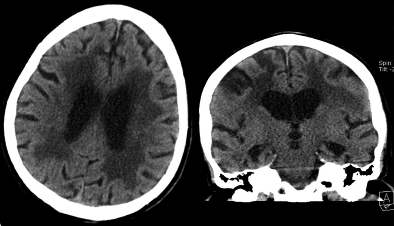4 Beeldvormende diagnostiek bij dementie: inventarisatie van de praktijk Figuur 1 Axiale en coronale coupe van een CT cerebrum van een 82-jarige man met uitgebreide witte stofafwijkingen (Fazekas 3),