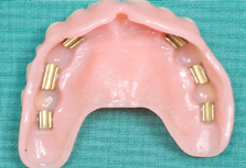 Figuur 3: klikgebit voor de onderkaak op vier implantaten met verbindingsstaafjes Figuur 4: implantaten in de bovenkaak met Verbindingsstaafjes Figuur 5: klikgebit met hulzen die