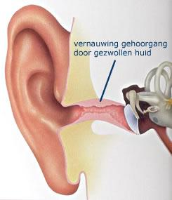 De aanleiding voor de operatie. (meatoplastiek) De gehoorgang kan in aanleg nauw zijn. Ook kan het door botuitstulpingen of goedaardige aangroei van kraakbeenachtig weefsel vernauwd zijn geraakt.