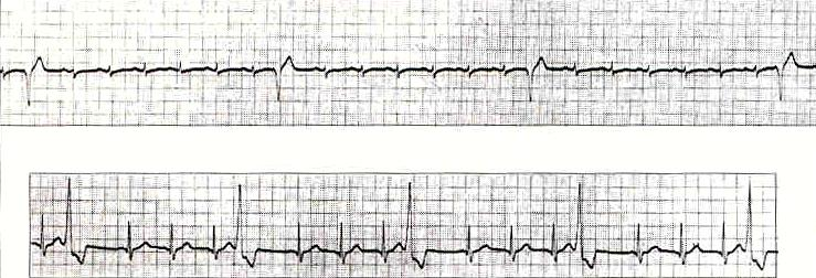 Parasystolie Is een dubbel ritme,veroorzaakt door twee pacemakers waarvan er één ectopisch is (en meestal in de kamer gelegen).