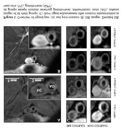 Contrastversterkte MRI van atherosclerose in konijnenaorta s met behulp van gadofosveset In hoofdstuk 4 onderzochten wij het potentieel van het albuminebindende contrastmiddel gadofosveset voor de