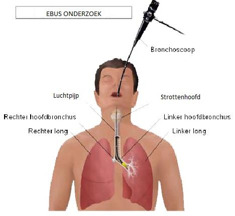 De longarts brengt de EBUSbronchoscoop in via een endotracheale tube tot in de luchtwegen. Via de echokop kijkt de arts doorheen de luchtpijpwand naar de klieren.