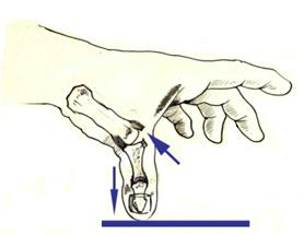 Duimspalk Indicatie Peesletsel duim. Rustspalk (bij overbelasting problemen b.v. tendinitis). Bennetfractuur en Rolandofractuur Bandletsel (mediaalcollateraal bandletsel, o.a. skiduim).