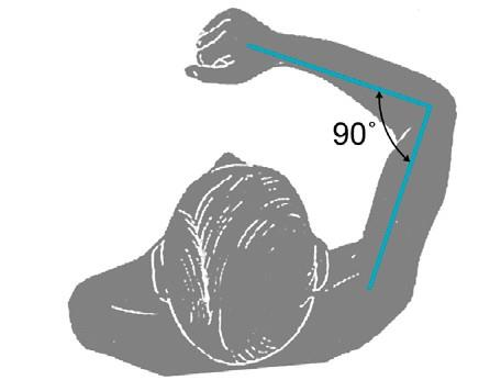 Bovenarmspalk Indicatie Antebrachiifractuur. Monteggiafractuur (=fractuur van prox. 1 /3 deel van ulna en luxatie van radius kopje) heeft een operatie-indicatie.