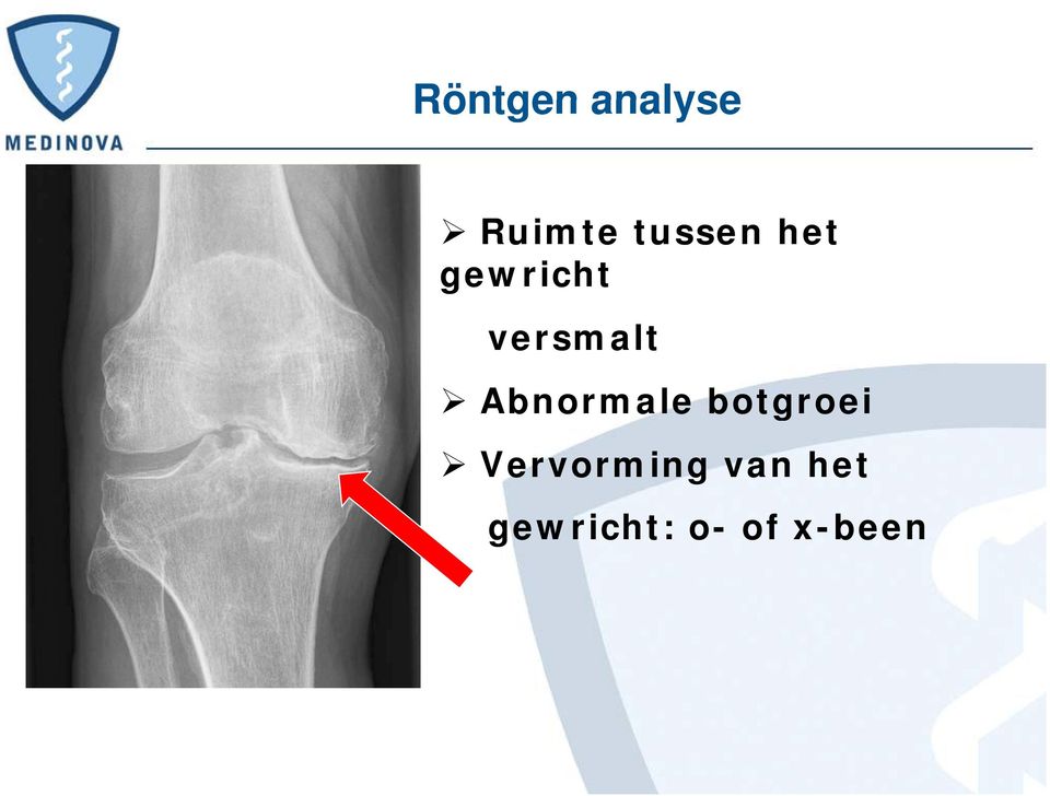 versmalt Abnormale botgroei