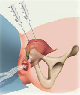 Vaginaal netje - perigee (AMS): bij behandeling van een blaaszakking wordt de blaas in een meer normale positie teruggebracht door versteviging van de vaginale voorwand.