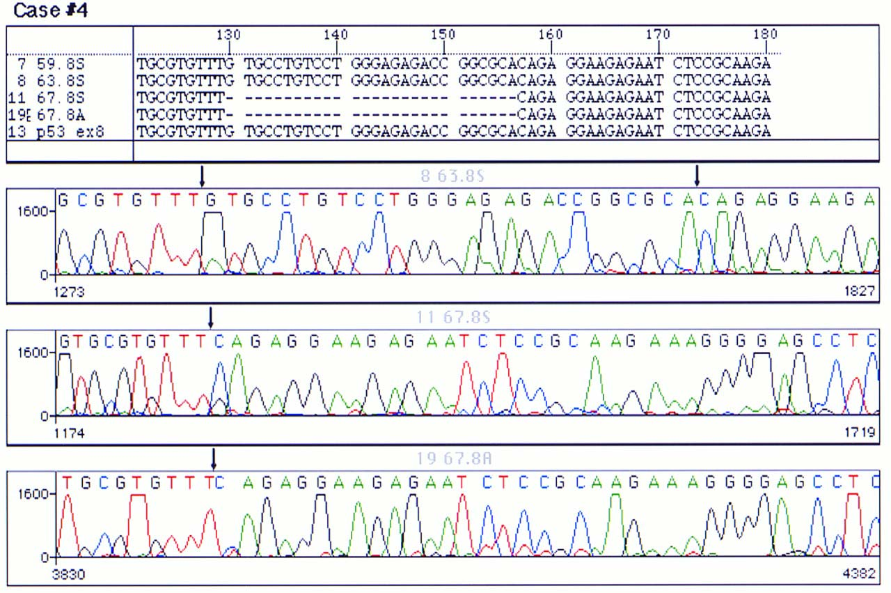 P53 mutatie: in frame met deletie van 27 basen in exon 8 Lens D et