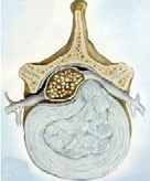 Hernia Een hernia is een ander woord voor een uitstulping. Een uitstulping van de tussenwervelschijf wordt ook wel een Hernia Nuclei Pulposi (HNP) genoemd.