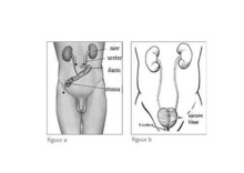 1. Het urinestoma volgens Bricker (figuur a) Bij deze operatie wordt een stukje dunne darm van ongeveer 15 20 cm vrijgemaakt, waarna de urineleiders in het vrijgemaakte stukje darm (darmlisje) worden