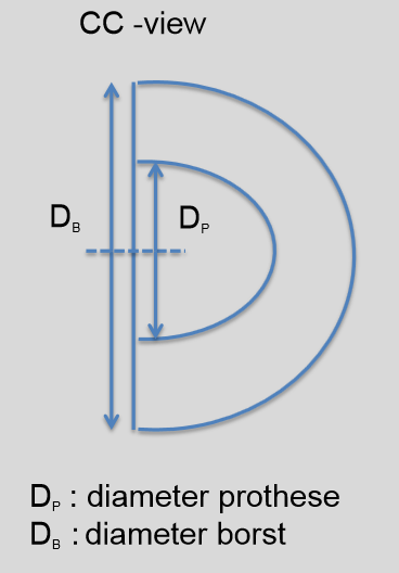 Pagina 21 van 44 De gehanteerde rekenregel: 1. Op de CC-opname wordt de diameter van de prothese bepaald (=D p ) 2. Op de CC-opname wordt de diameter van de borst bepaald (=D b ) 3.