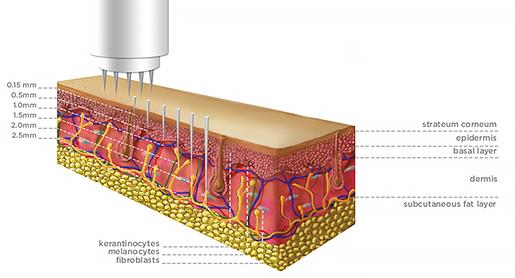 Microneedling huidverbetering op top-niveau Microneedling is een behandeling waarbij 9 fijne naaldjes de huid snel en gecontroleerd penetreren.